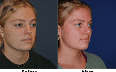 Charlotte’s Top Nose Job Surgeon for Nostril Reduction