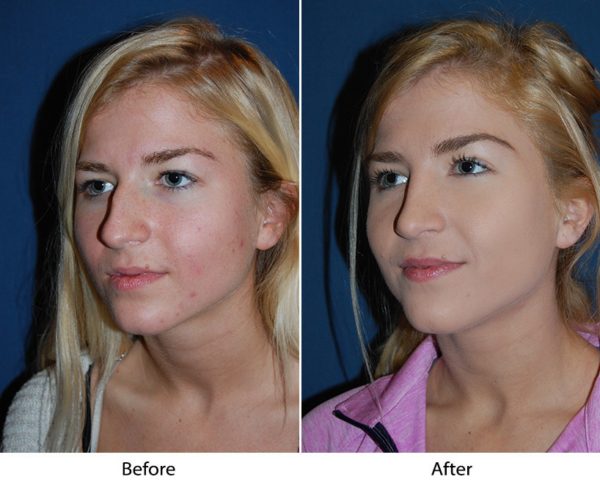 Charlotte’s Best Rhinoplasty Specialist: Facial Asymmetry