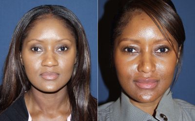 Charlotte’s top rhinoplasty specialist for Alar Rim Deformities