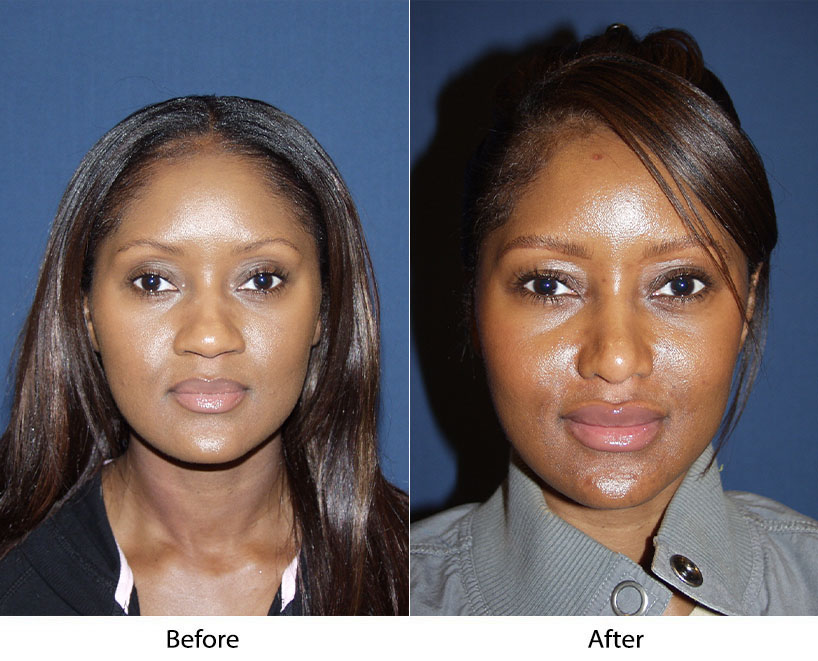 Rhinoplasty specialist