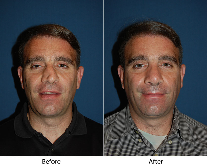 Rhinoplasty Surgeon in Charlotte NC for Skin Conditions