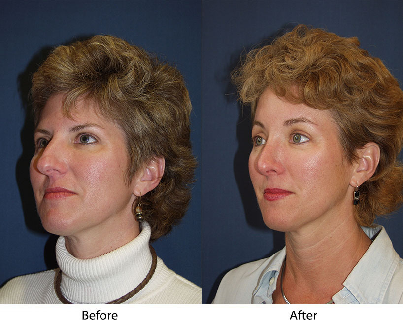 Charlotte’s top nose job surgeon: Essential Pre-Op Tips