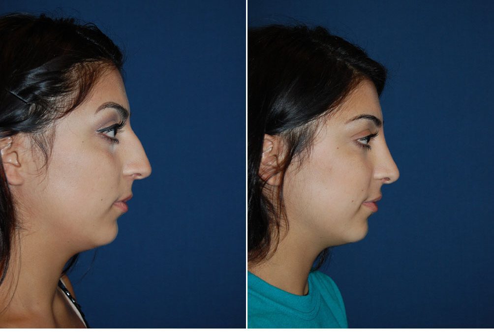 Charlotte’s top teen rhinoplasty surgeons discusses timing