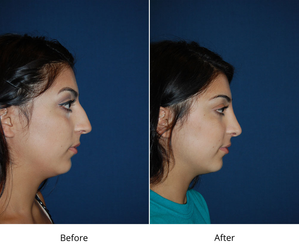 Teen rhinoplasty surgeons